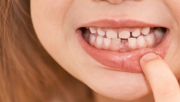 WHAT TO DO WHEN YOUR CHILD LOSES TEETH?