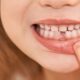 WHAT TO DO WHEN YOUR CHILD LOSES TEETH?